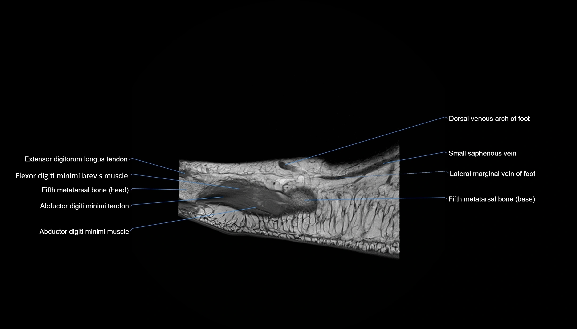 MRI mid foot sagittal cross sectional anatomy 3T  radiology  image-img-00001-00004.webp